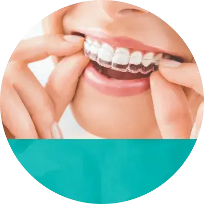 マウスピース矯正